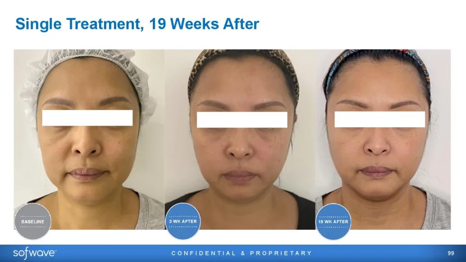 2024%EA%B5%90%EC%9C%A1%EC%9E%90%EB%A3%8C_Sofwave_Update_Overview_2024-55.jpg?type=w1