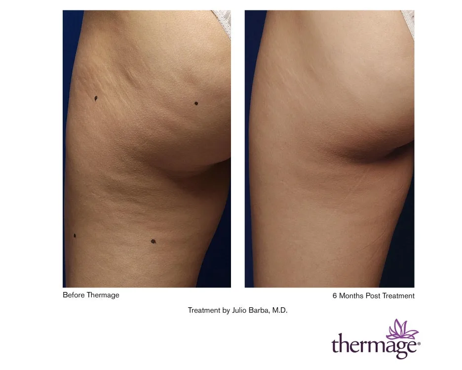 E168-ThermageNXT_LoRes.jpg?type=w1