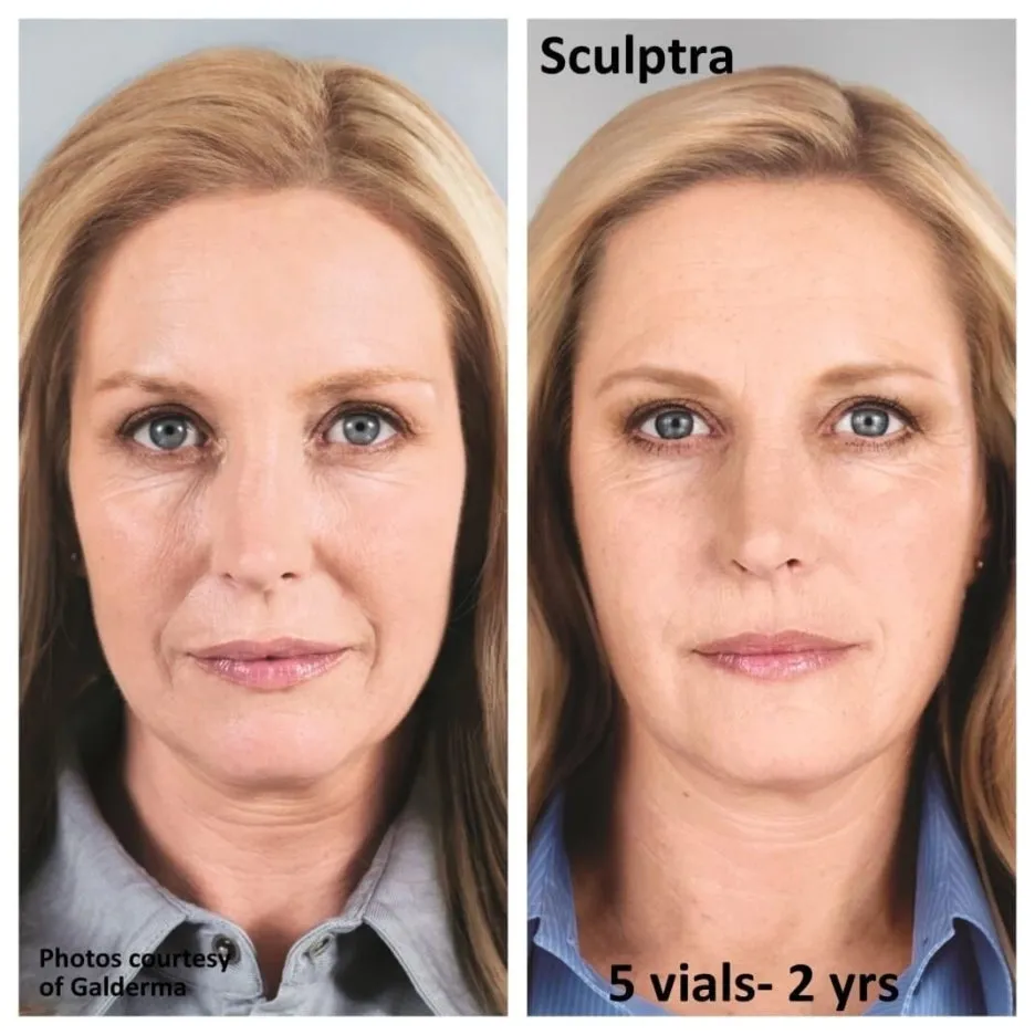 sculptra-results-2df9f440.jpeg?type=w1