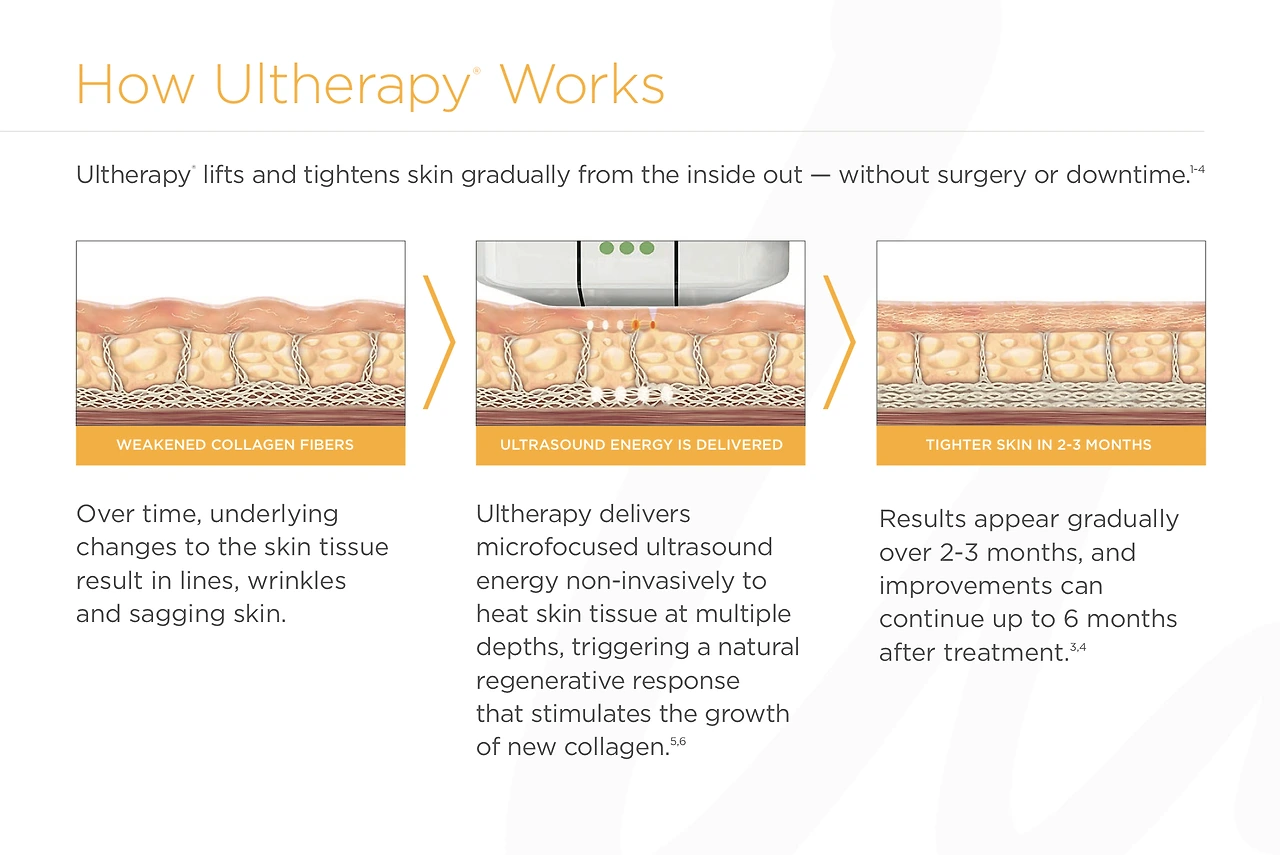 How Ultherapy Works.jfif
