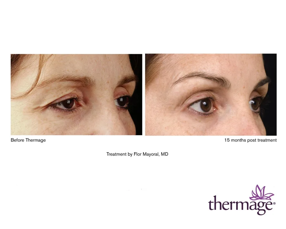 E157-ThermageNXT_LoRes.jpg?type=w1