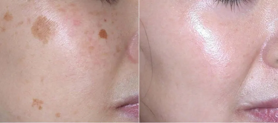 %EC%A0%84%ED%9B%84%EC%82%AC%EC%A7%84excelV_29.jpg?type=w1