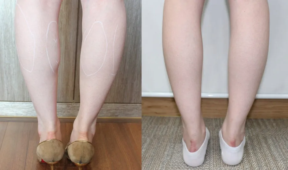 %EC%A2%85%EC%95%84%EB%A6%AC_%EC%A0%84%ED%9B%84.jpg?type=w1