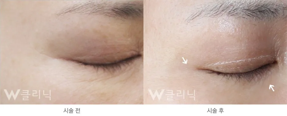 160323_W%EB%A6%AC%EC%A5%AC%EB%9E%80%EC%A0%84%ED%9B%84%EC%82%AC%EC%A7%842.jpg?type=w1