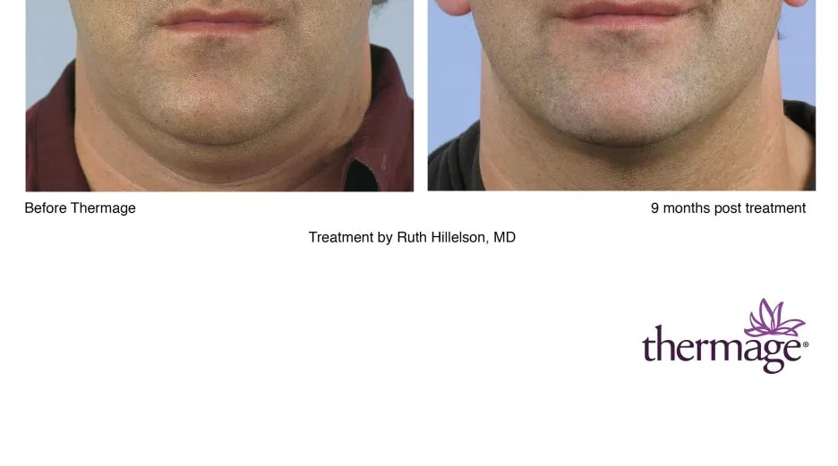 E146-ThermageNXT_LoRes.jpg?type=w1