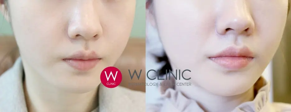 20%EB%B3%BC%ED%95%84%EB%9F%AC_%EB%B8%94%EB%A1%9C%EA%B1%B0_%EC%A0%84%ED%9B%84.jpg?type=w1