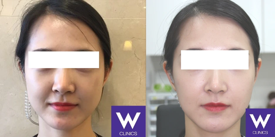 filler_lift_ba_2.png?type=w1