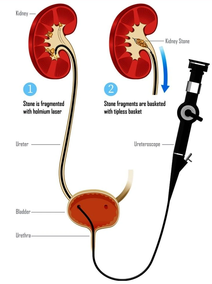 R.2f36fcafd3e2d422b12142cc5dbaacc4?rik=XImH6wTr8xX7Pg&riu=http%3a%2f%2fwww.mitrurologyassociates.com%2fresources%2fassets%2fimages%2fRIRS-Retrograde-Intrarenal-Surgery-Uteroscopy-in-Navi-Mumbai.png&ehk=L0cUcD2bpXf2JCHvN5BhT1gAxoCQt1gnzrlvC6hVa0s%3d&risl=&pid=ImgRaw&r=0