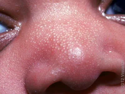 5_sebaceous_hyperplasia_what_does_baby_acne_look_like_2181120.jpg?format=pjpg&auto=webp&width=704