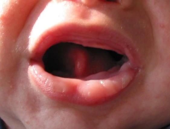Figure%205.%20Neonatal%20Sucking%20Pads%20of%20the%20Lips.jpg?VersionId=Pu26ntqINZ_lTAqDX6xc56H0YLlcMQVc
