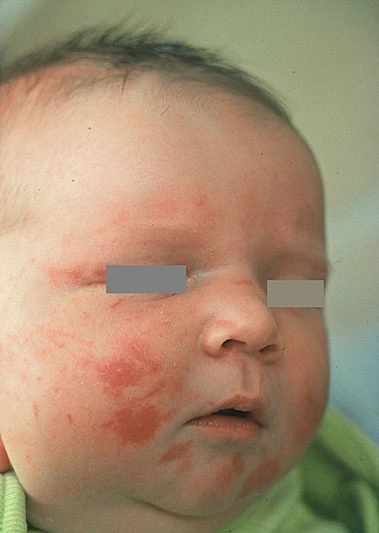 R.dea13a0f5a0c328f0f8ea47a4a65911f?rik=s4YflbaXrFdoTw&riu=http%3a%2f%2fwww.danderm-pdv.is.kkh.dk%2fatlas%2fpics%2f3%2f3-75-2.jpg&ehk=goVFiRAIs%2bpo5Gs0HjfDMNyq8x4qI3qQxGaa7v9Q5Gs%3d&risl=&pid=ImgRaw&r=0