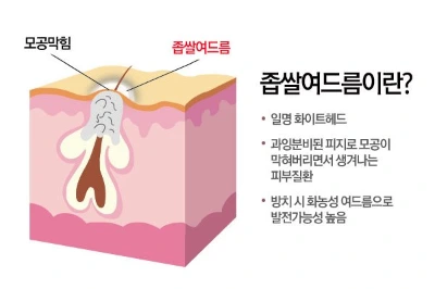 %EC%A2%81%EC%8C%80%EC%97%AC%EB%93%9C%EB%A6%84%EC%9D%B4%EB%9E%80.jpg?type=w1200