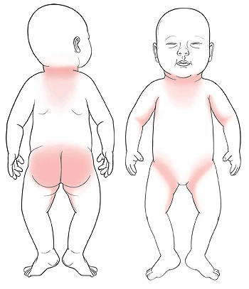 outline-of-baby-from-back-with-shaded-areas-around-neck-and-on-buttocks-and-inner-thighs-outline-of-baby-from-front-with-shaded