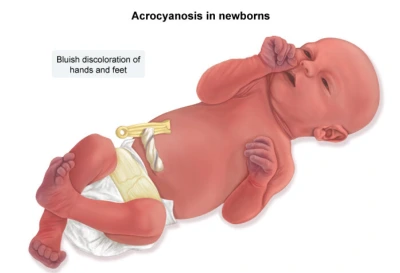 acrocyanosis-labeled.jpg?format=1500w
