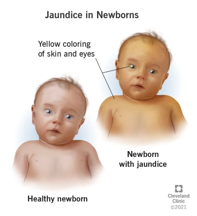 22263-jaudince-in-newborns
