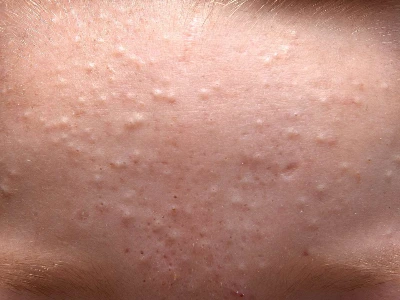 Health-133.acne-001-5569be33e2174af18cc1513bdfa52610.jpeg