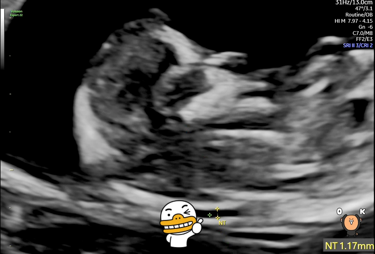 12주차 태아 목둘레.PNG