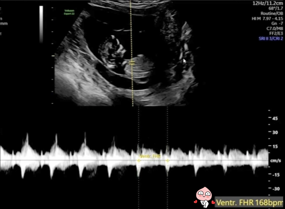 12주 태아 심박수 측정.PNG