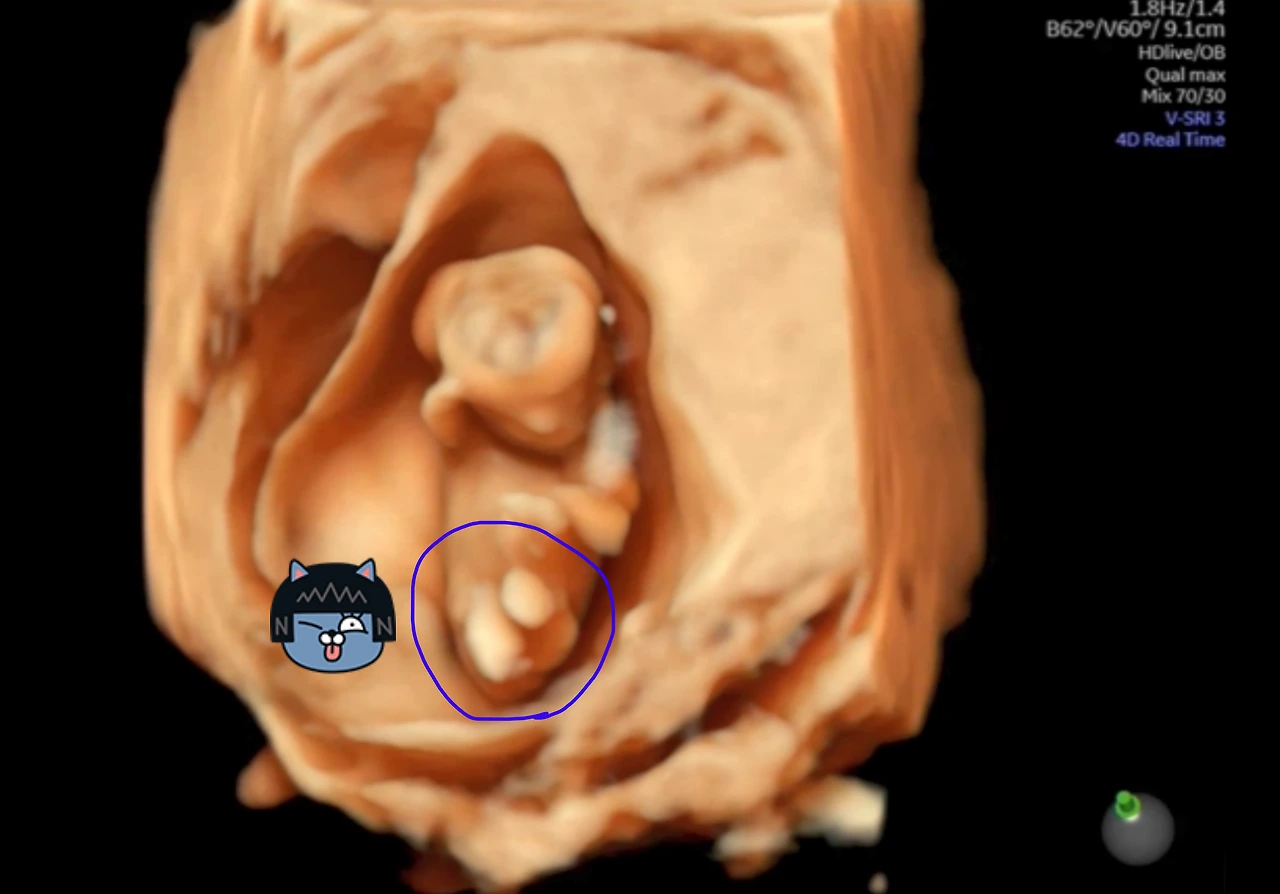 12주 입체 초음파(다리꼬기).PNG