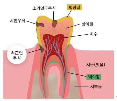 치근면 우식증 -1.JPG