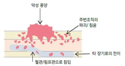 구강암 -01.JPG