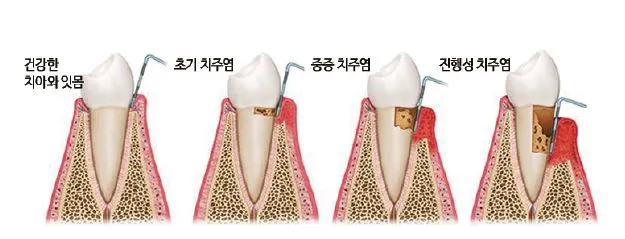 치근면 우식증 -2.JPG