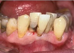 치근면 우식증 -3.JPG