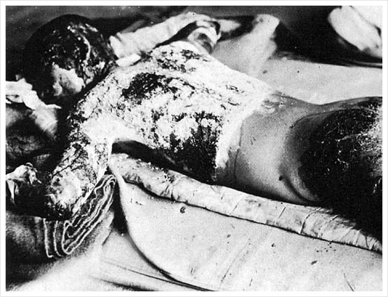 790px-Victim_of_Atomic_Bomb_002.jpg?type=w1