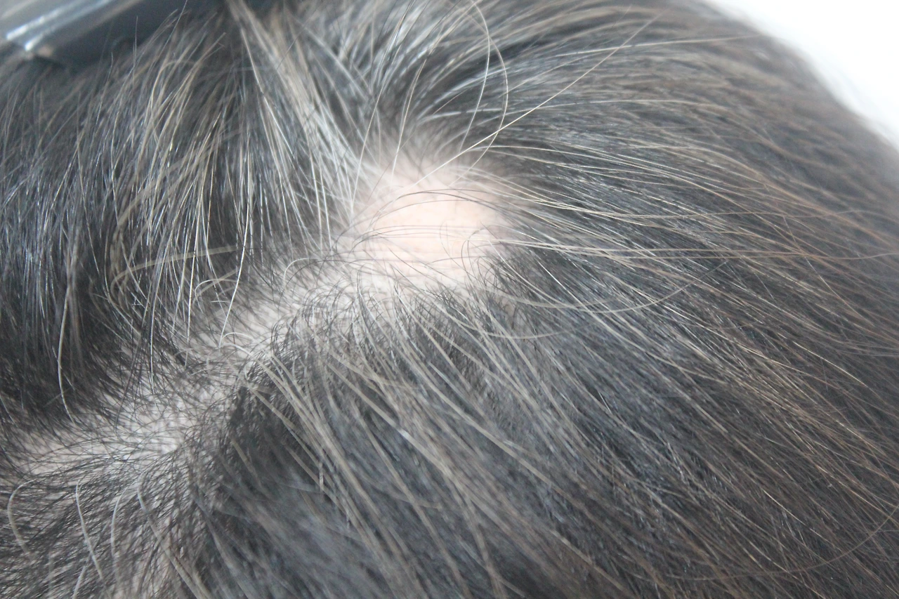 정수리 원형탈모.JPG