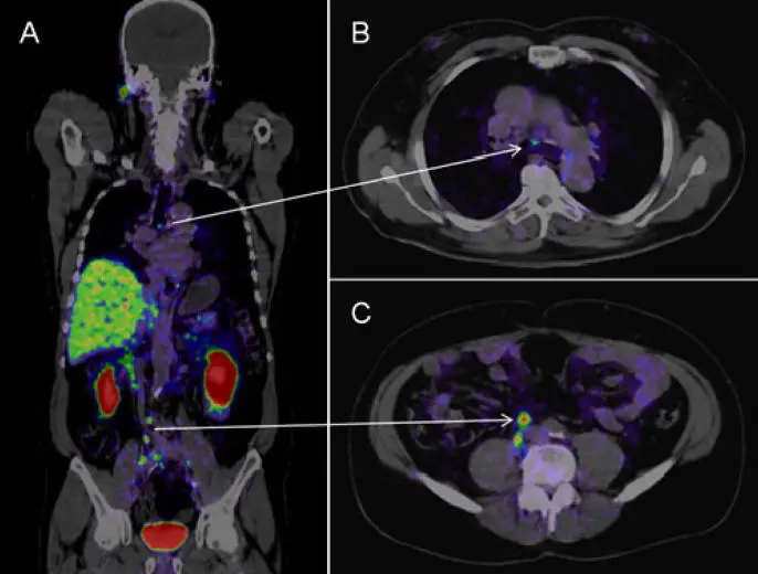 detecting-metastases-in-localized-prostate-cancer.jpg?h=39316187&itok=ca1eZssw