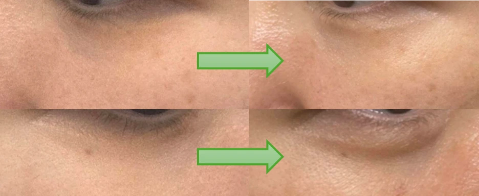 %EB%A6%AC%ED%88%AC%EC%98%A4%EB%88%88%EA%B0%80%ED%9A%A8%EA%B3%BC.png?type=w1