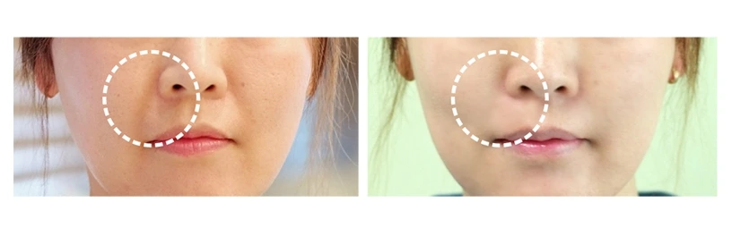 %EC%8A%A4%EC%BB%AC%ED%8A%B8%EB%9D%BC_%EC%A0%84%ED%9B%84%EC%82%AC%EC%A7%84_%ED%8C%94%EC%9E%90%EC%A3%BC%EB%A6%84.jpg?type=w1