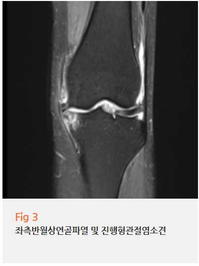 무릎뒤 오금 통증 병원 어디 가야 좀 걸을 수 있을까?