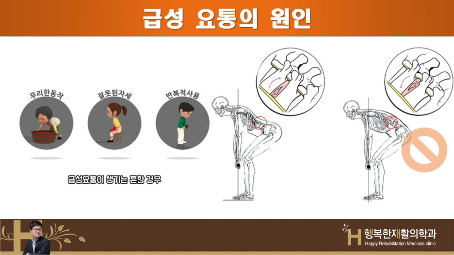 왜 당신의 요통은 사라지지 않나(2)급성요통 원인