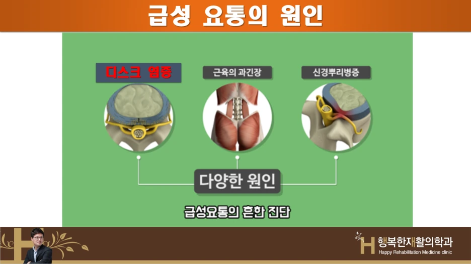 왜 당신의 요통은 사라지지 않나(2)급성요통 원인