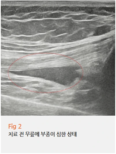 무릎 뒤 다리 오금 통증 때문에 병원 3군데 다녔는데