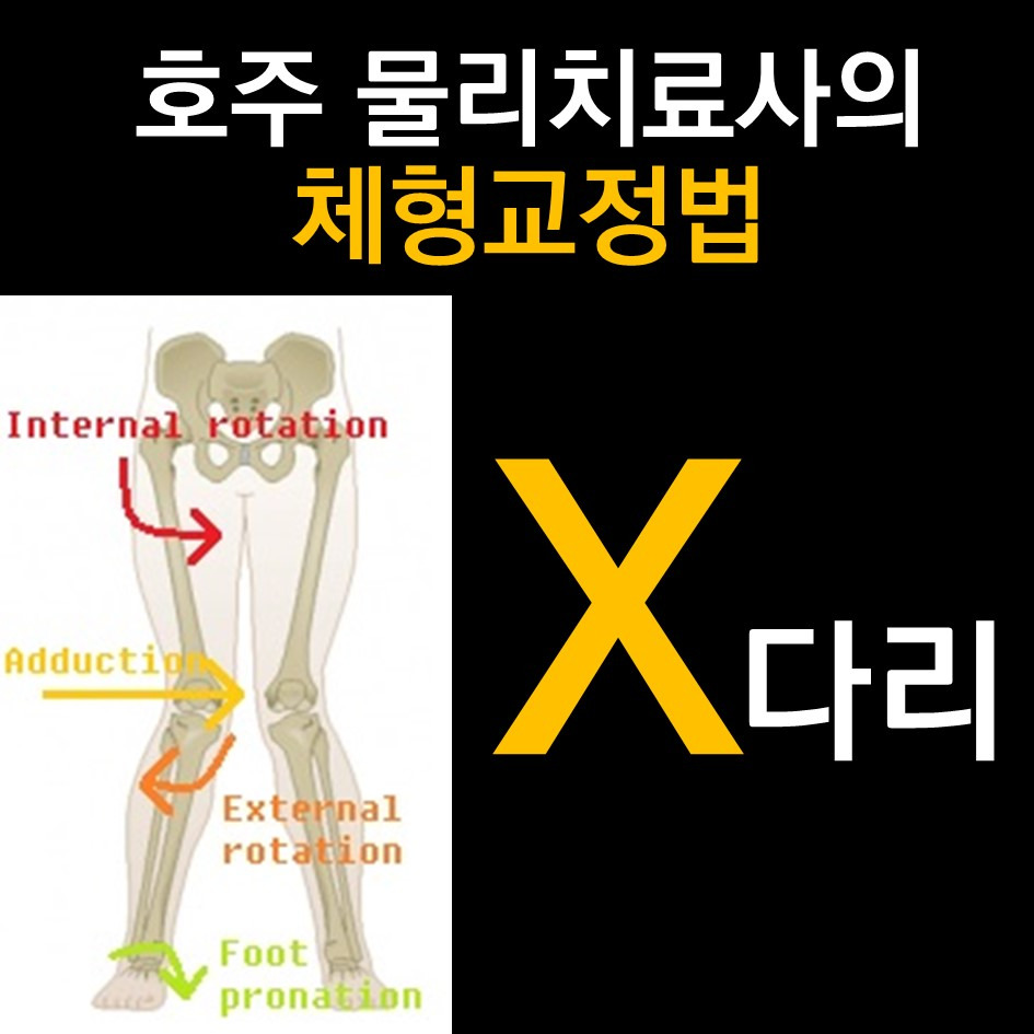 호주 물리치료사가 알려주는 체형교정법(X다리,외반슬)