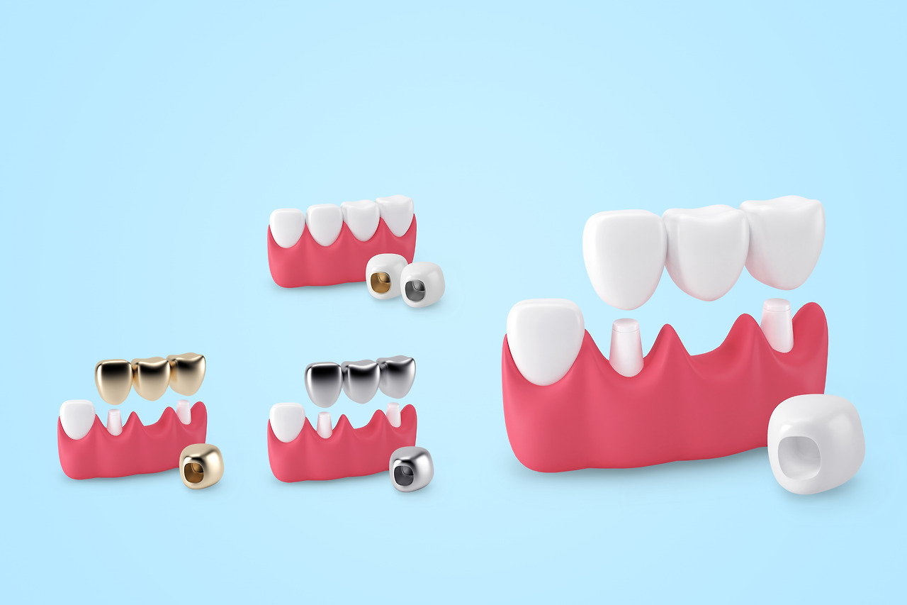 상실치아 대체하는 치아브릿지, 치료 과정과 장단점은?