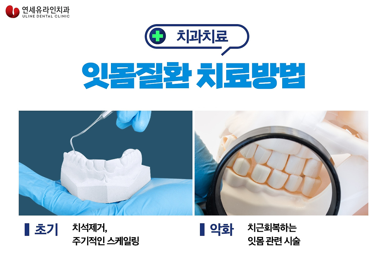 치석제거, 잇몸관리 철저히 하는 방법 1