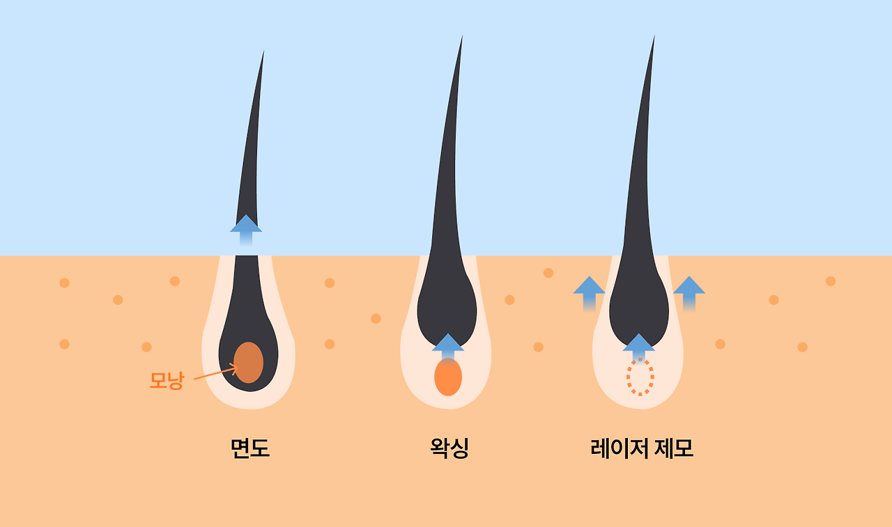 레이저 제모, 영구 제모가 가능할까?