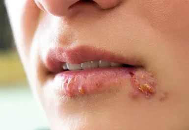 남자친구가 헤르페스(Herpes)래요.