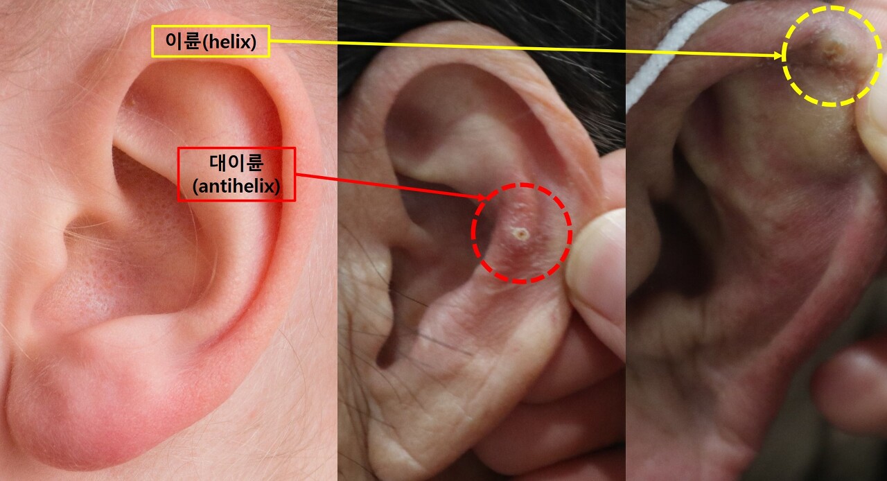 귀에 통증을 유발하는 만성 결절성 연골피부염