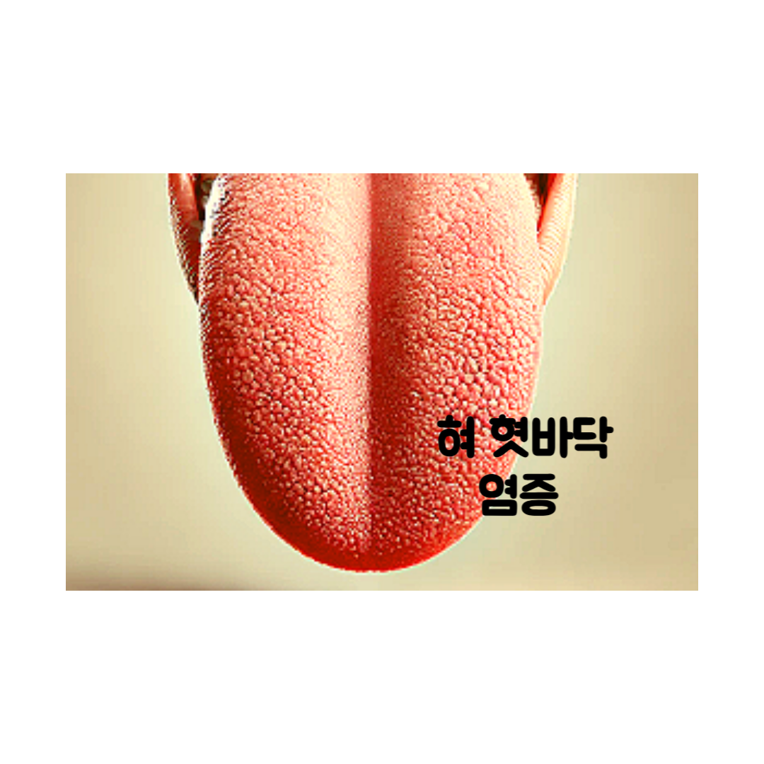 혀 혓바닥 염증 원인과 증상 알아보기