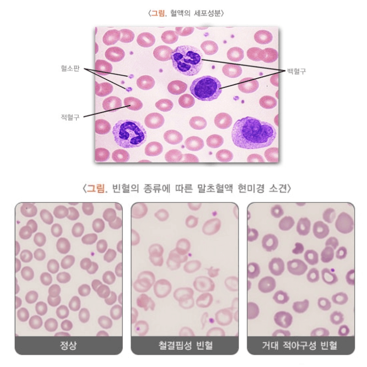 빈혈 완전 정복 : 빈혈에도 종류가 있어요! 2 ywAAAAAAQABAAACAUwAOw==