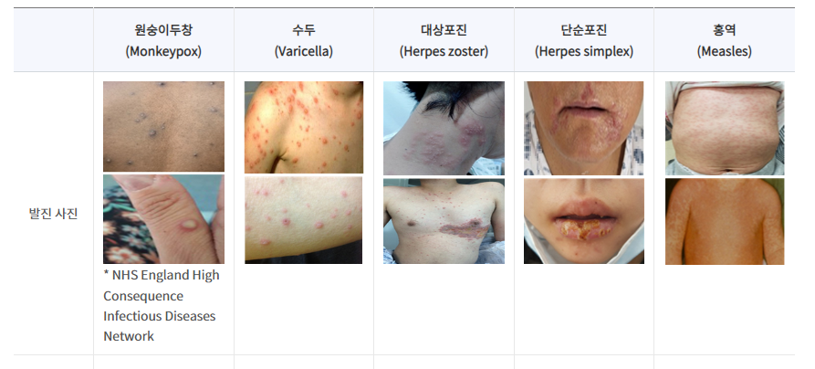 원숭이두창 감염경로 증상 다른 피부질환과 차이점 7 ywAAAAAAQABAAACAUwAOw==