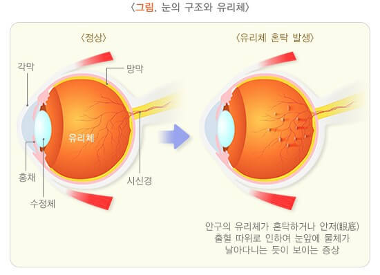 눈 앞에 날파리가? : 비문증(muscae volitantes) 2 눈의 구조와 유리체