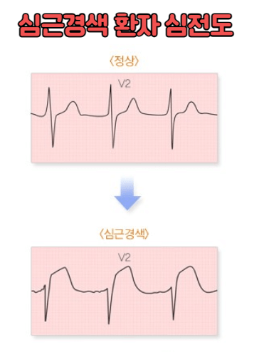 급성 심근경색의 원인 및 치료와 예방에 대한 모든 것 2 ywAAAAAAQABAAACAUwAOw==
