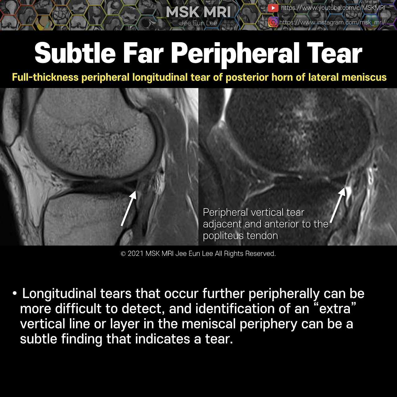 [Tear_06] Far Peripheral Tear Longitudinal Meniscal Tear -04