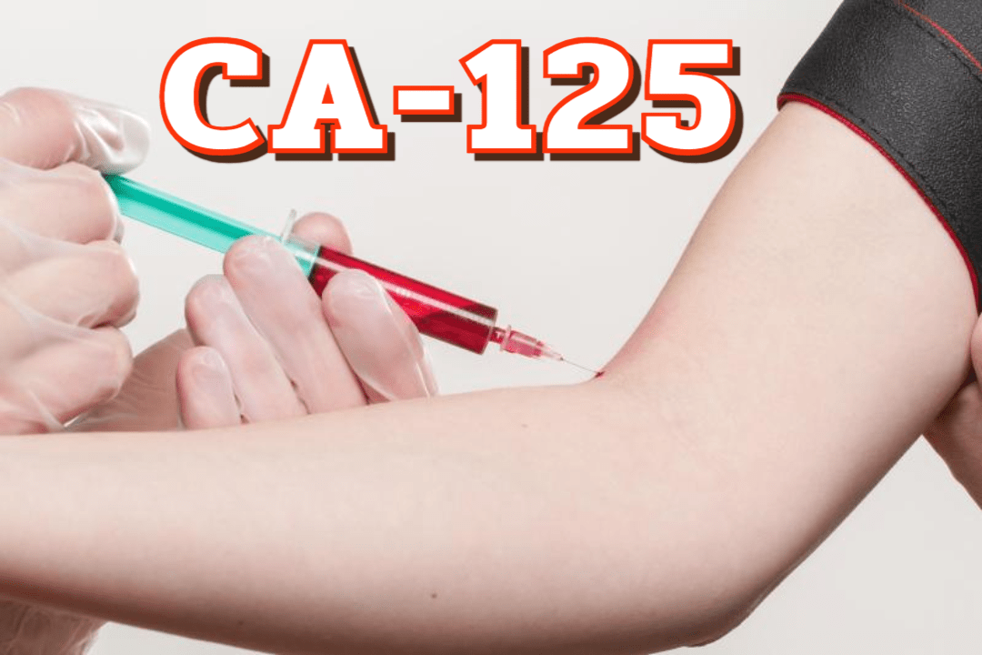 종양표지자 검사 CA-125 1 CA-125