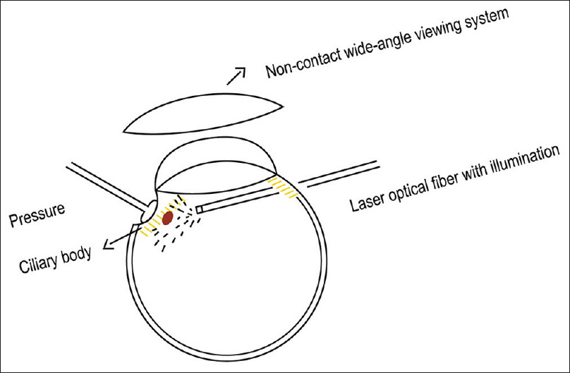 Diode Laser TransScleral CPC, 동공경유 광응고술, 눈속경유섬모체 광응고술